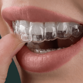 invisalign-braces-leicester-m