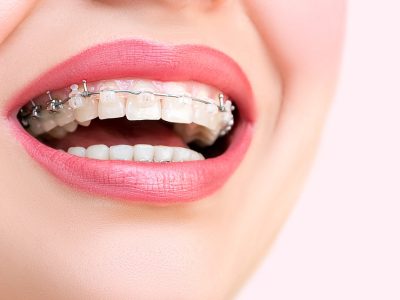 shutterstock_352848512 self ligating