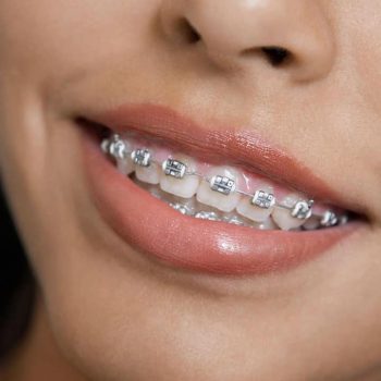 traditional-metal-braces-phoenix